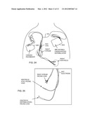 MEDICAL LEAD HAVING A BANDSTOP FILTER EMPLOYING A CAPACITOR AND AN     INDUCTOR TANK CIRCUIT TO ENHANCE MRI COMPATIBILITY diagram and image