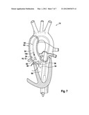 MEDICAL IMPLANT, PARTICULARLY VALVE IMPLANT, FOR IMPLANTATION IN AN ANIMAL     AND/OR HUMAN BODY AND METHOD, PARTICULARLY PRODUCTION METHOD, FOR     PRODUCING AN IMPLANTATION APPARATUS FOR THE MEDICAL IMPLANT diagram and image