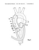 MEDICAL VALVE IMPLANT FOR IMPLANTATION IN AN ANIMAL BODY AND/OR HUMAN BODY diagram and image
