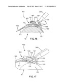 Buckle With Strapping Supports diagram and image