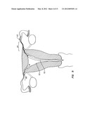 OCCLUSION DEVICES AND METHODS diagram and image