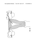 OCCLUSION DEVICES AND METHODS diagram and image