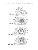 OCCLUSION DEVICES AND METHODS diagram and image