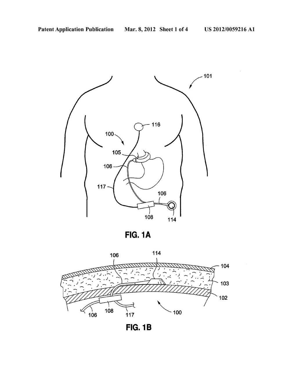 REMOTELY ADJUSTABLE GASTRIC BANDING SYSTEM - diagram, schematic, and image 02