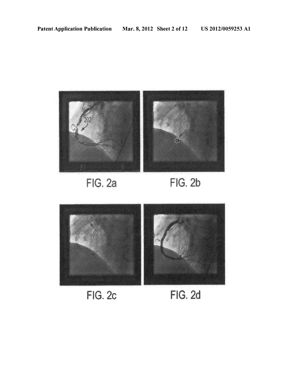 Method and System for Image Based Device Tracking for Co-registration of     Angiography and Intravascular Ultrasound Images - diagram, schematic, and image 03