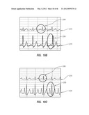 APPARATUS AND METHOD FOR CATHETER NAVIGATION USING ENDOVASCULAR ENERGY     MAPPING diagram and image