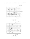 APPARATUS AND METHOD FOR CATHETER NAVIGATION USING ENDOVASCULAR ENERGY     MAPPING diagram and image