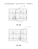 APPARATUS AND METHOD FOR CATHETER NAVIGATION USING ENDOVASCULAR ENERGY     MAPPING diagram and image