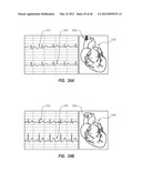 APPARATUS AND METHOD FOR CATHETER NAVIGATION USING ENDOVASCULAR ENERGY     MAPPING diagram and image