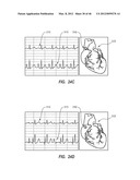 APPARATUS AND METHOD FOR CATHETER NAVIGATION USING ENDOVASCULAR ENERGY     MAPPING diagram and image