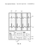 APPARATUS AND METHOD FOR CATHETER NAVIGATION USING ENDOVASCULAR ENERGY     MAPPING diagram and image