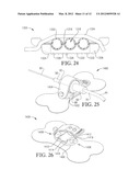 INTRAVENOUS CATHETER ANCHORING DEVICE diagram and image