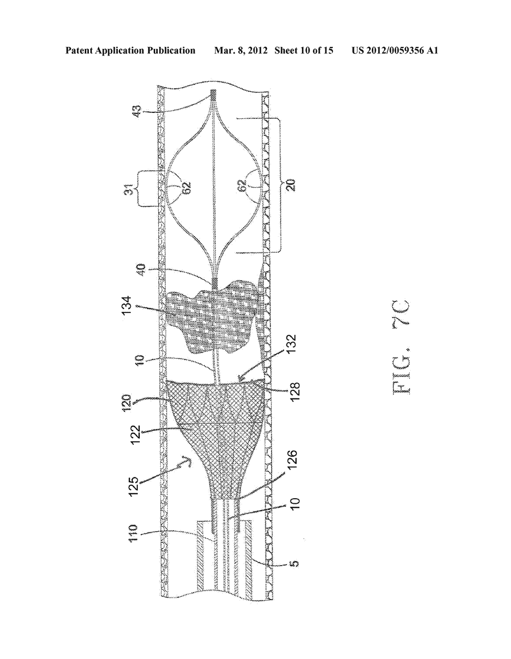 DEVICE AND METHOD FOR REMOVING MATERIAL FROM A HOLLOW ANATOMICAL STRUCTURE - diagram, schematic, and image 11