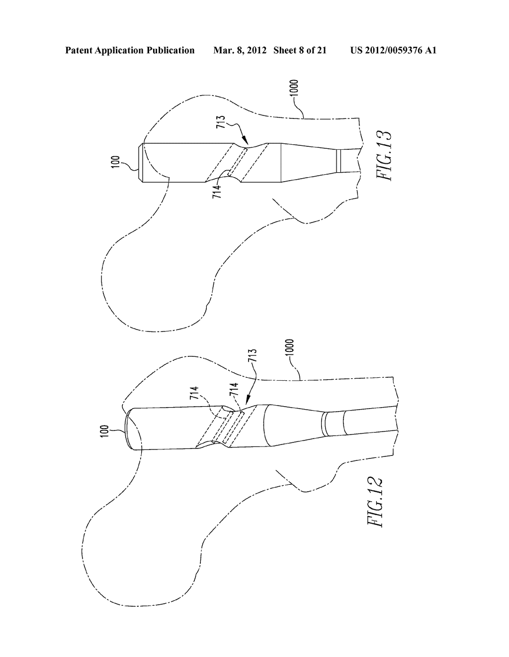 COMPOSITE INTERNAL FIXATORS - diagram, schematic, and image 09