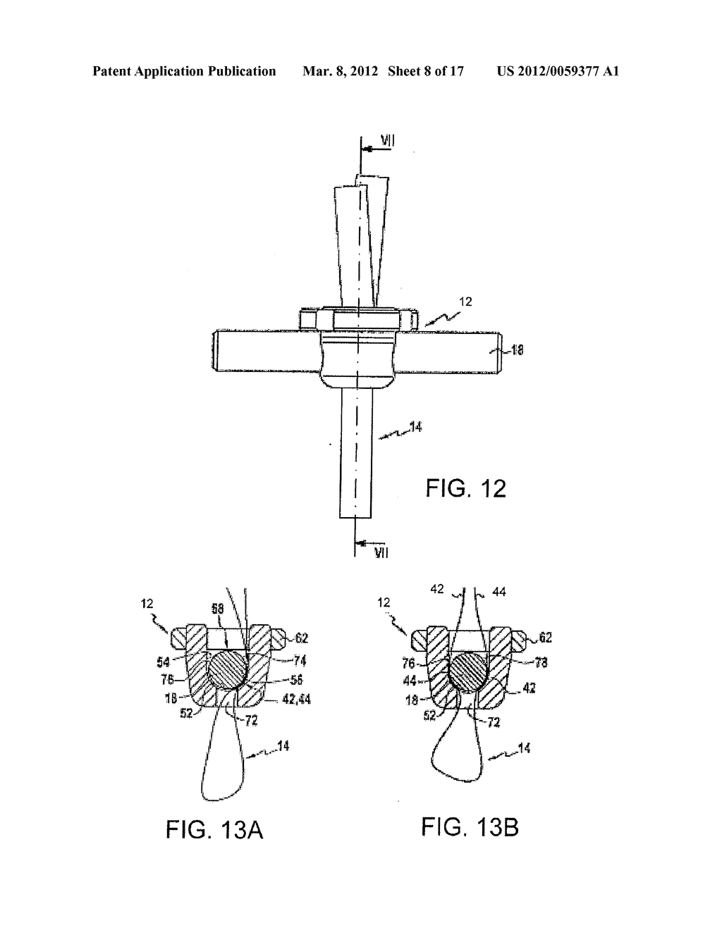 BONE FIXING SYSTEM AND METHOD OF USE - diagram, schematic, and image 09