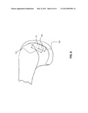 GUIDE SYSTEMS AND METHODS FOR LIGAMENT RECONSTRUCTION diagram and image