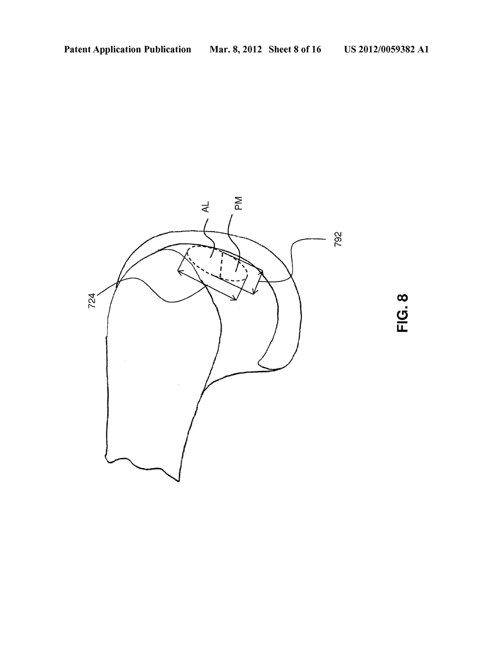 GUIDE SYSTEMS AND METHODS FOR LIGAMENT RECONSTRUCTION - diagram, schematic, and image 09