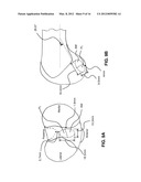 GUIDE SYSTEMS AND METHODS FOR LIGAMENT RECONSTRUCTION diagram and image