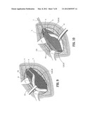 ABSORBABLE FASTENER AND APPLYING APPARATUS diagram and image