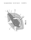 ABSORBABLE FASTENER AND APPLYING APPARATUS diagram and image