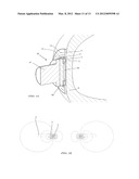 Magnetic Ventricular Connector diagram and image