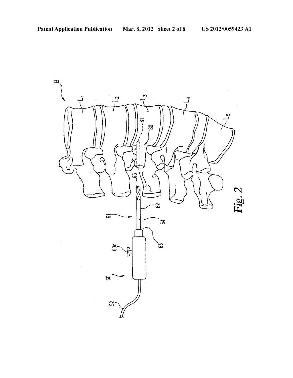 Deformity Correction Using Neural Integrity Monitoring - diagram, schematic, and image 03