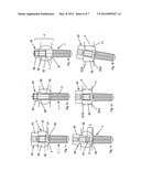 DEVICE FOR THE DYNAMIC FIXATION OF BONES diagram and image