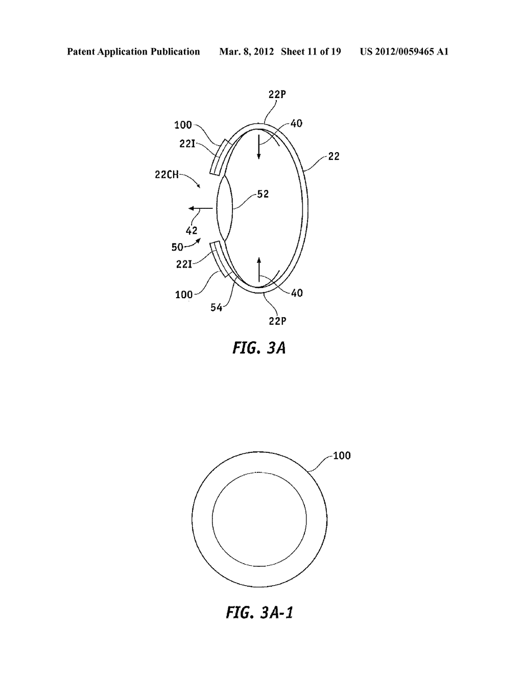 CAPSULAR MEMBRANE IMPLANTS TO INCREASE ACCOMMODATIVE AMPLITUDE - diagram, schematic, and image 12