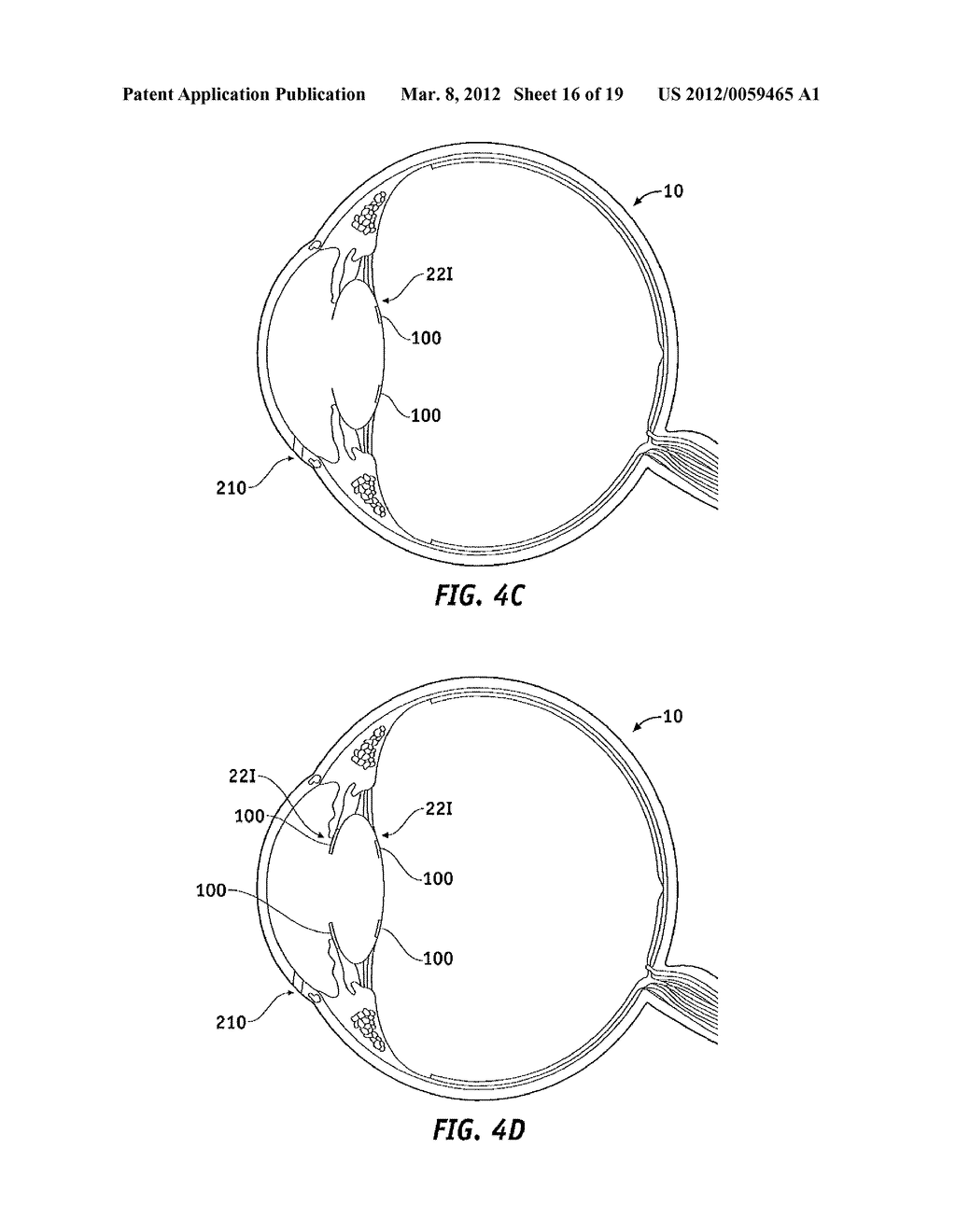 CAPSULAR MEMBRANE IMPLANTS TO INCREASE ACCOMMODATIVE AMPLITUDE - diagram, schematic, and image 17