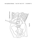 TOOLS AND METHODS FOR SPINAL FUSION diagram and image