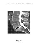 Spinal Fusion Cage, Method of Design, and Method of Use diagram and image