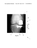 ORTHOPEDIC INTERFACE DEVICE AND METHOD diagram and image