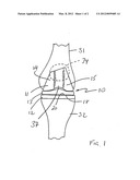 Total Knee Trochlear System diagram and image