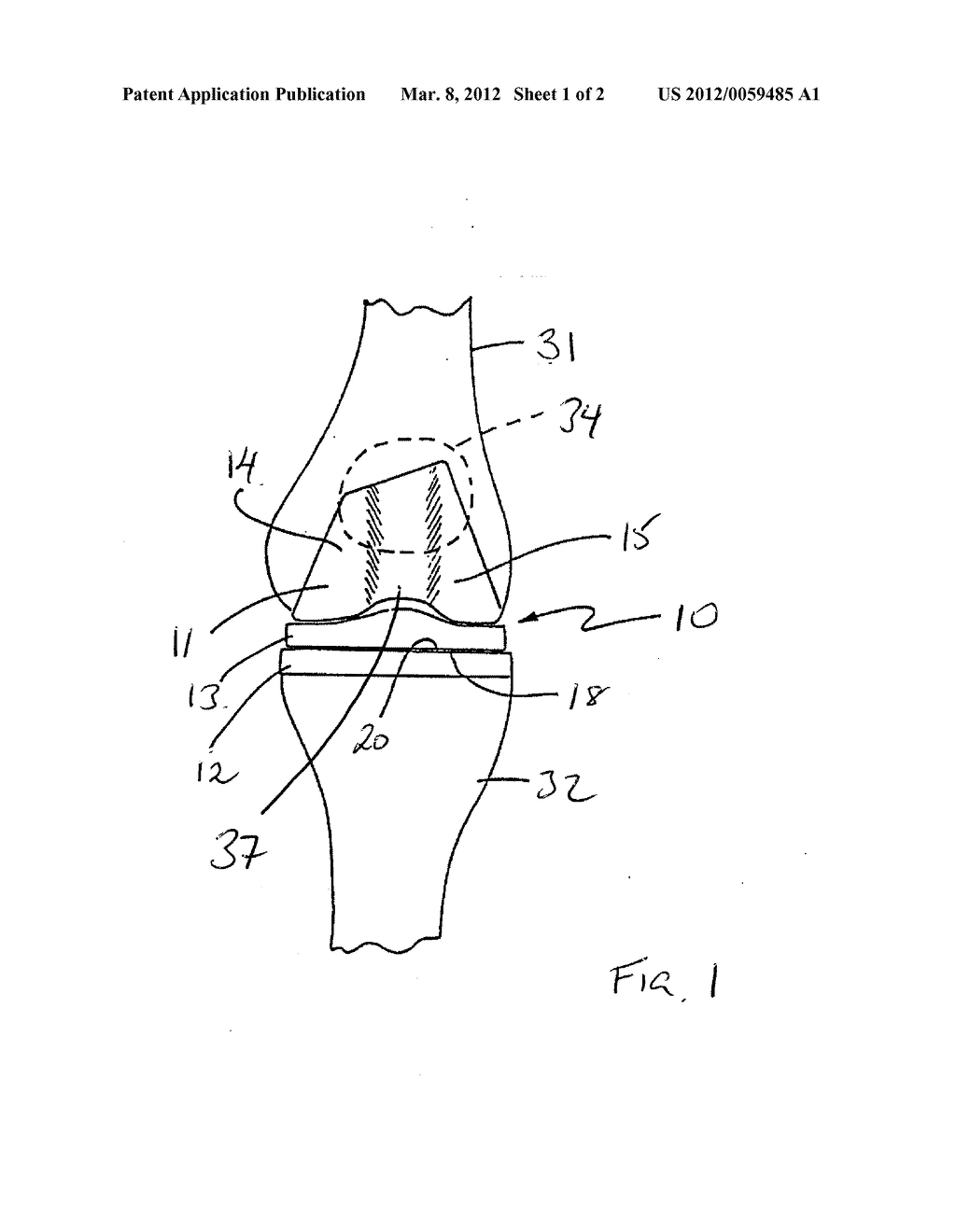 Total Knee Trochlear System - diagram, schematic, and image 02