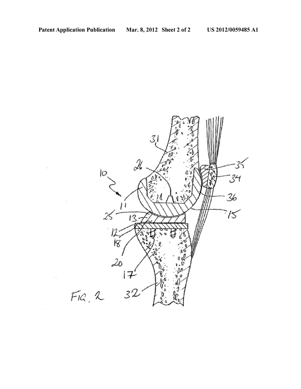 Total Knee Trochlear System - diagram, schematic, and image 03