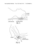 Apparatus and methods for preventing and/or healing pressure ulcers diagram and image