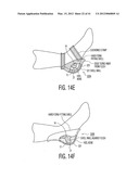 Apparatus and methods for preventing and/or healing pressure ulcers diagram and image