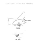 Apparatus and methods for preventing and/or healing pressure ulcers diagram and image