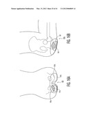 Apparatus and methods for preventing and/or healing pressure ulcers diagram and image