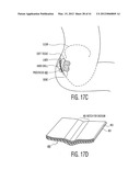 Apparatus and methods for preventing and/or healing pressure ulcers diagram and image