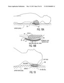 Apparatus and methods for preventing and/or healing pressure ulcers diagram and image