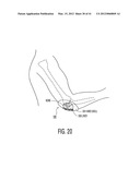 Apparatus and methods for preventing and/or healing pressure ulcers diagram and image