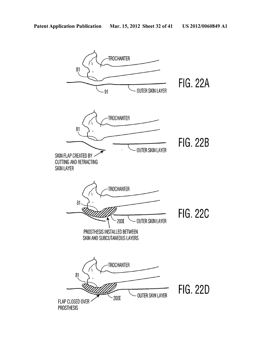 Apparatus and methods for preventing and/or healing pressure ulcers - diagram, schematic, and image 33