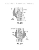 Apparatus and methods for preventing and/or healing pressure ulcers diagram and image