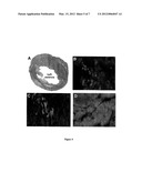 Use of Multipotent Adult Stem Cells in Treatment of Myocardial Infarction     and Congestive Heart Failure diagram and image