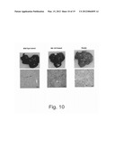 Methods for Treating Lysosomal Acid Lipase Deficiency in Patients diagram and image