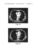 TREATMENT OF CANCER diagram and image