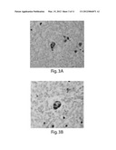 TREATMENT OF CANCER diagram and image