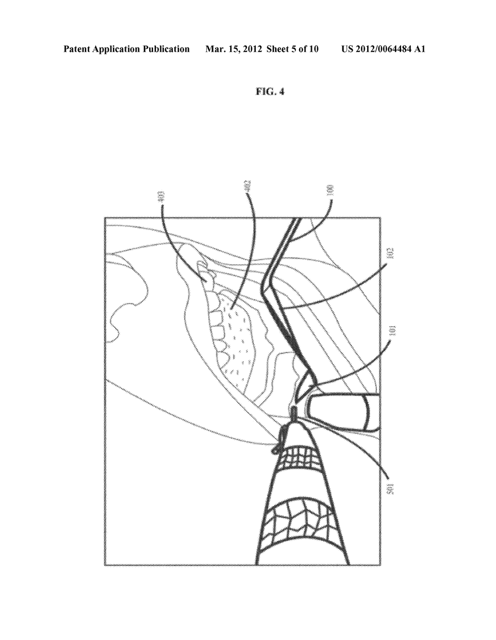 INFERIOR ALVEOLAR NERVE (IAN) PROTECTOR INSTRUMENT - diagram, schematic, and image 06