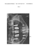 INFERIOR ALVEOLAR NERVE (IAN) PROTECTOR INSTRUMENT diagram and image